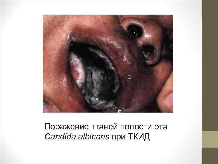 Поражение тканей полости рта Candida albicans при ТКИД 
