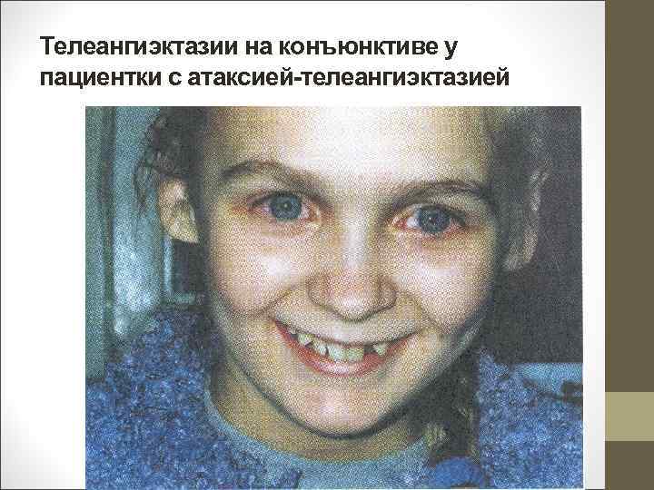 Телеангиэктазии на конъюнктиве у пациентки с атаксией-телеангиэктазией 