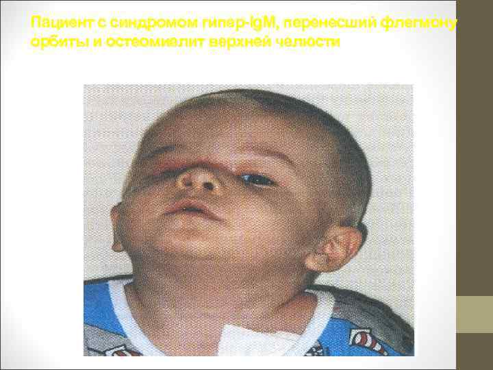 Пациент с синдромом гипер-Ig. M, перенесший флегмону орбиты и остеомиелит верхней челюсти 