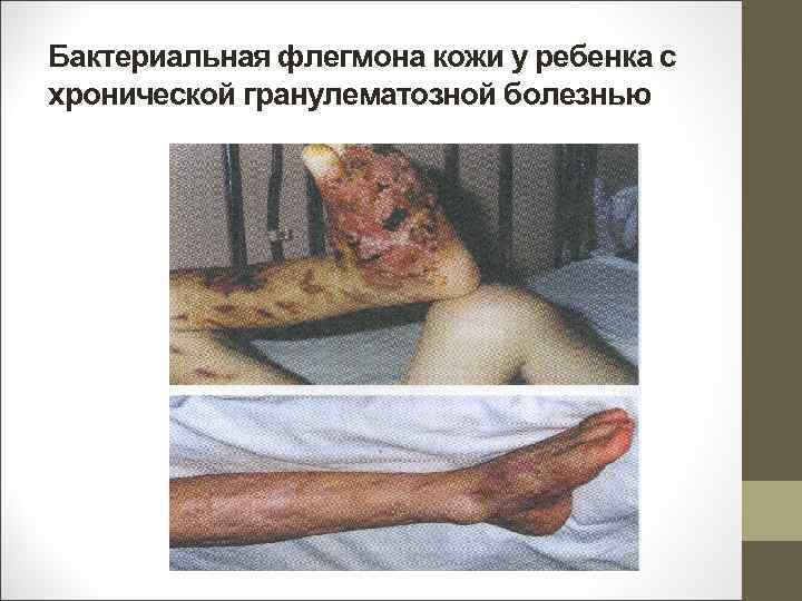 Бактериальная флегмона кожи у ребенка с хронической гранулематозной болезнью 