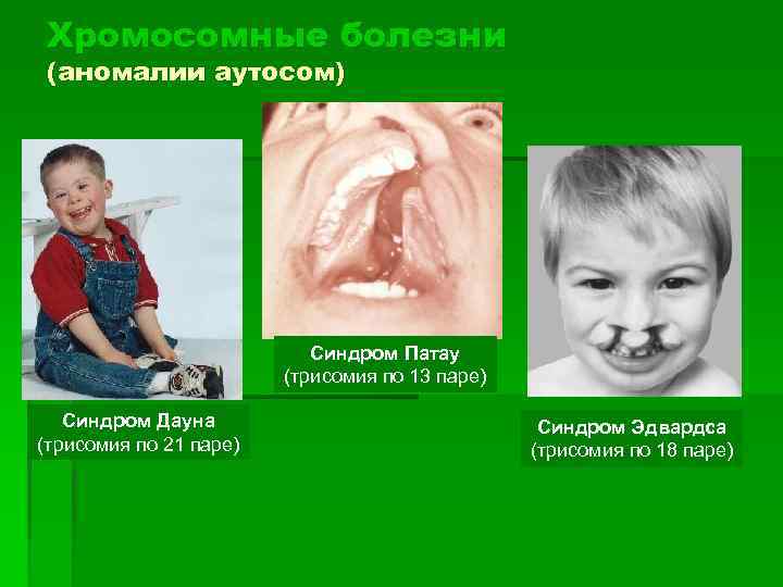 Хромосомные болезни (аномалии аутосом) Синдром Патау (трисомия по 13 паре) Синдром Дауна (трисомия по