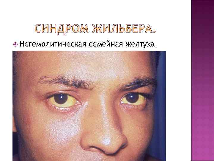  Негемолитическая семейная желтуха. 