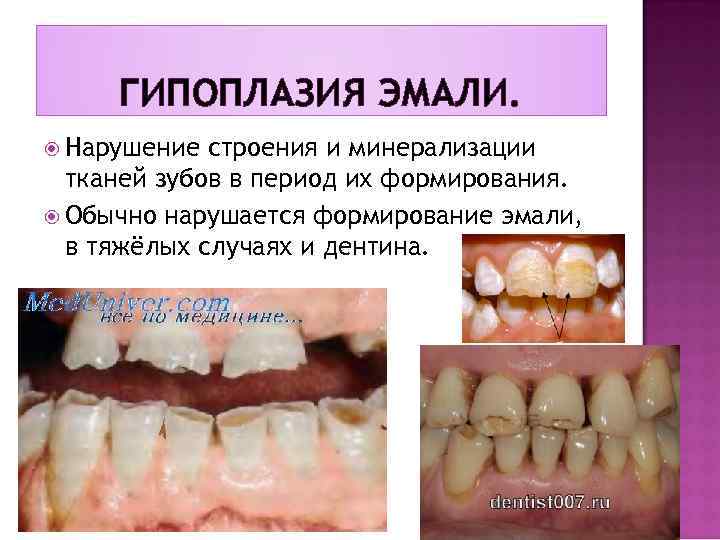 ГИПОПЛАЗИЯ ЭМАЛИ. Нарушение строения и минерализации тканей зубов в период их формирования. Обычно нарушается