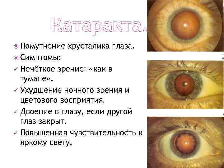 Катаракта. Помутнение хрусталика глаза. Симптомы: Нечёткое зрение: «как в тумане» . ü Ухудшение ночного