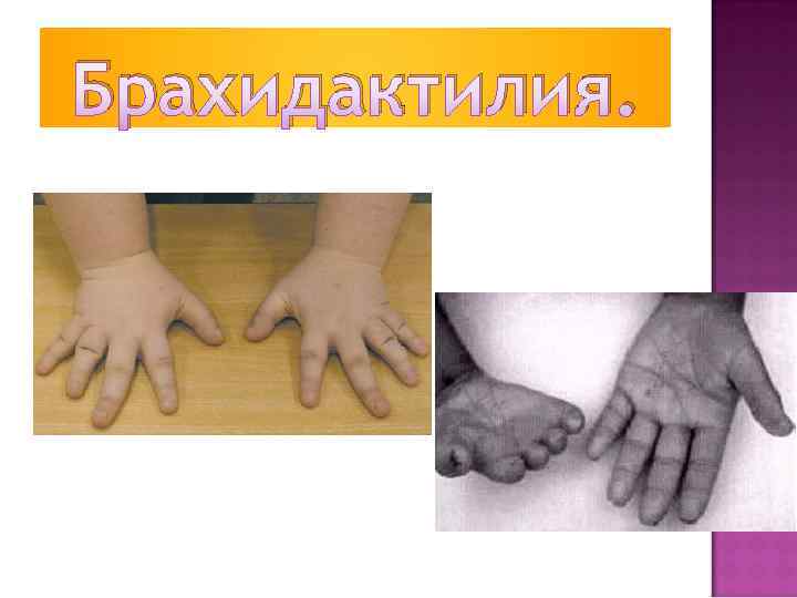 Брахидактилия. 