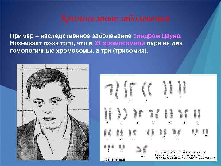 Хромосомные заболевания Пример – наследственное заболевание синдром Дауна. Возникает из-за того, что в 21