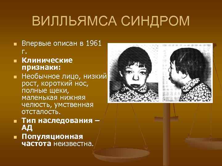  ВИЛЛЬЯМСА СИНДРОМ n Впервые описан в 1961 г. n Клинические признаки: n Необычное