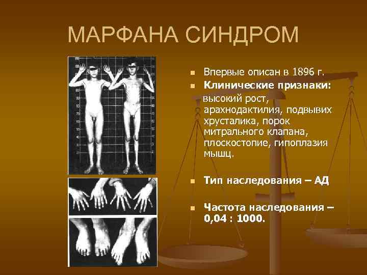 МАРФАНА СИНДРОМ n Впервые описан в 1896 г. n Клинические признаки: высокий рост, арахнодактилия,