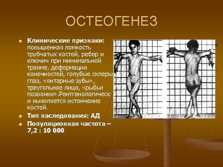  ОСТЕОГЕНЕЗ n Клинические признаки: повышенная ломкость трубчатых костей, ребер и ключич при минимальной