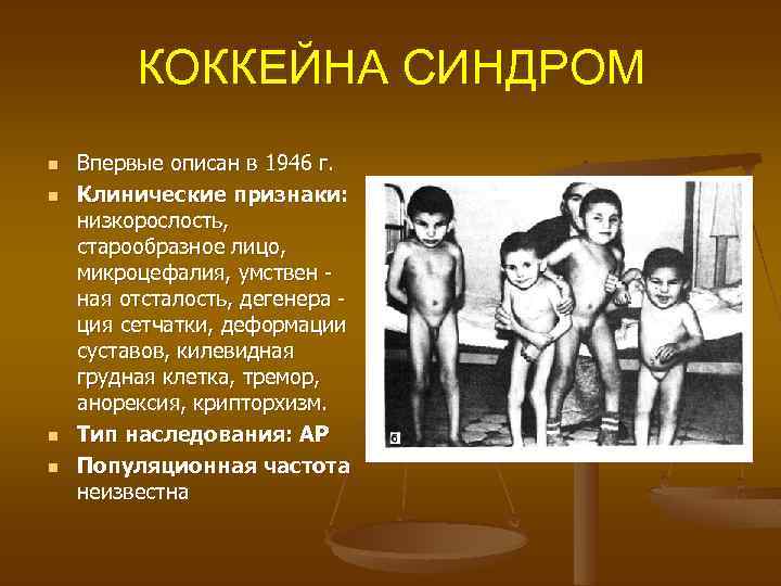  КОККЕЙНА СИНДРОМ n Впервые описан в 1946 г. n Клинические признаки: низкорослость, старообразное