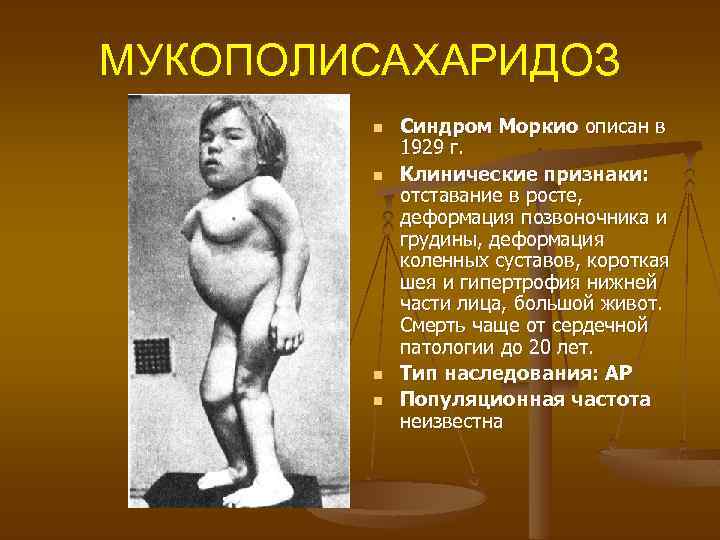 МУКОПОЛИСАХАРИДОЗ n Синдром Моркио описан в 1929 г. n Клинические признаки: отставание в росте,