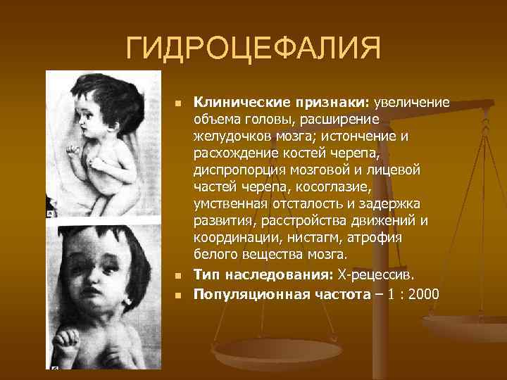 ГИДРОЦЕФАЛИЯ n Клинические признаки: увеличение объема головы, расширение желудочков мозга; истончение и расхождение костей