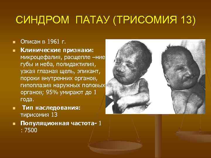 СИНДРОМ ПАТАУ (ТРИСОМИЯ 13) n Описан в 1961 г. n Клинические признаки: микроцефалия, расщепле