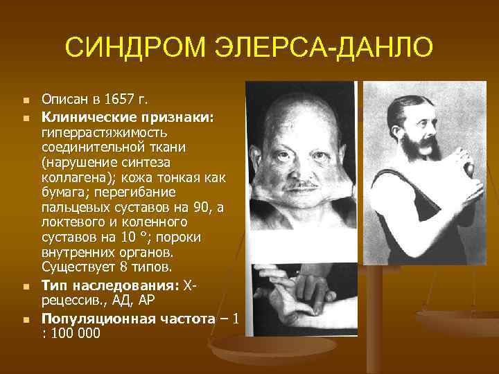  СИНДРОМ ЭЛЕРСА-ДАНЛО n Описан в 1657 г. n Клинические признаки: гиперрастяжимость соединительной ткани