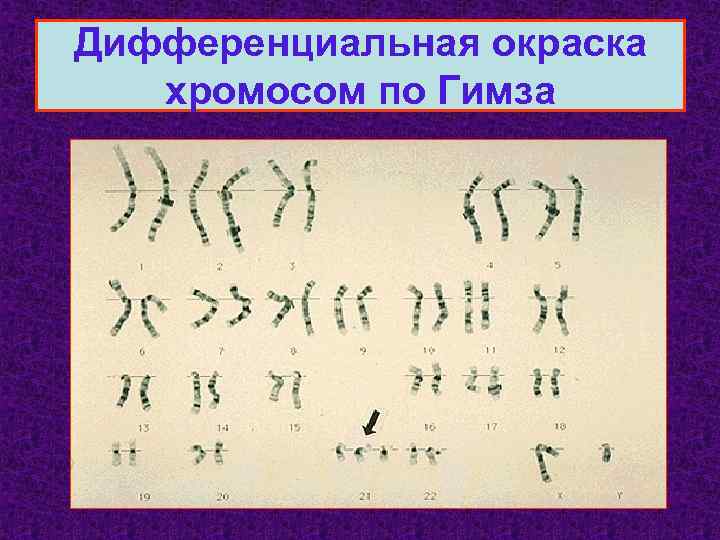 Дифференциальная окраска хромосом по Гимза 
