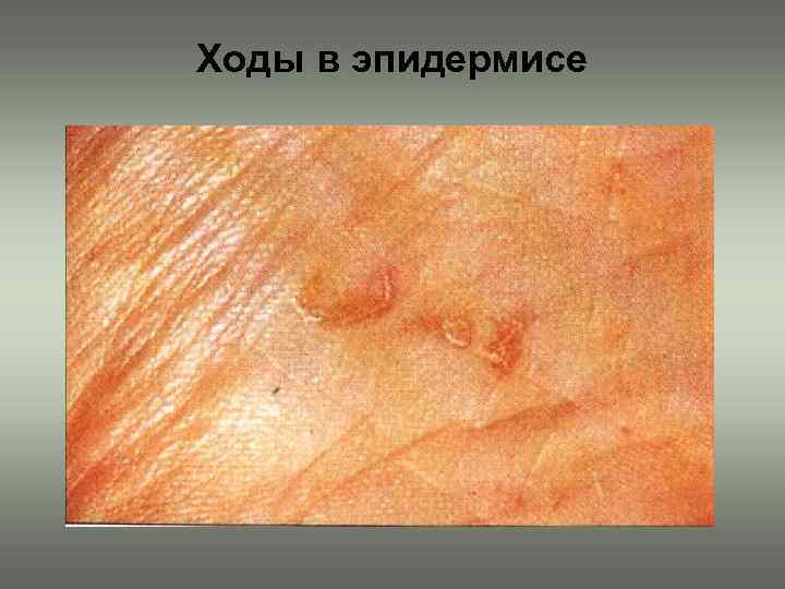 Ходы в эпидермисе 
