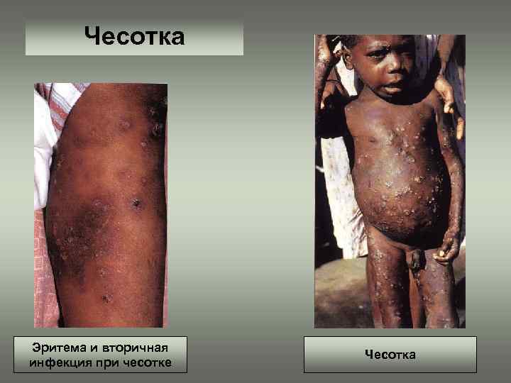 Чесотка Эритема и вторичная инфекция при чесотке Чесотка 