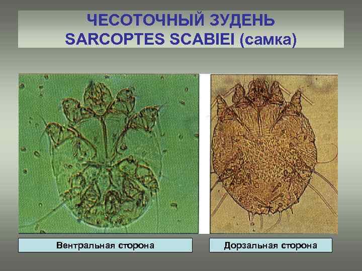 ЧЕСОТОЧНЫЙ ЗУДЕНЬ SARCOPTES SCABIEI (самка) Вентральная сторона Дорзальная сторона 
