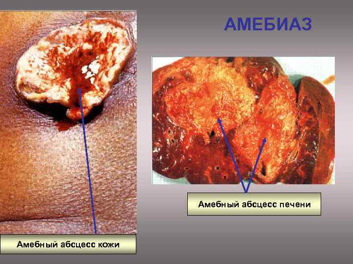 АМЕБИАЗ Амебный абсцесс печени Амебный абсцесс кожи 