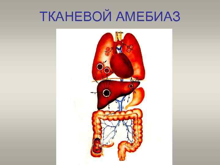 ТКАНЕВОЙ АМЕБИАЗ 