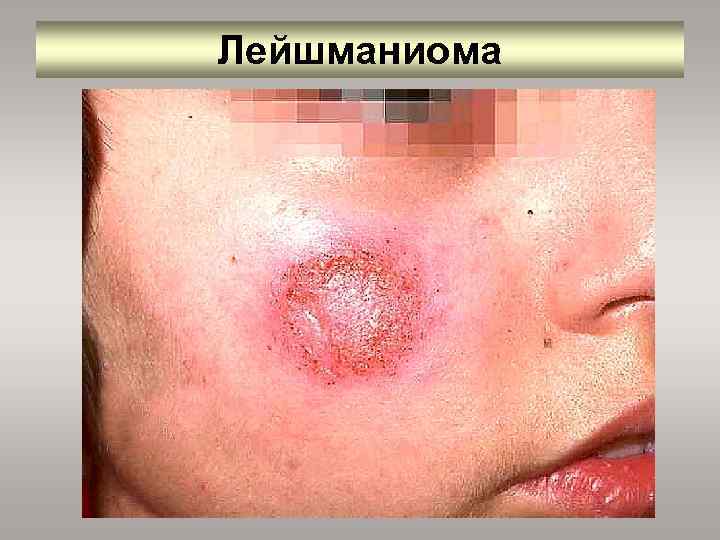 Лейшманиома 