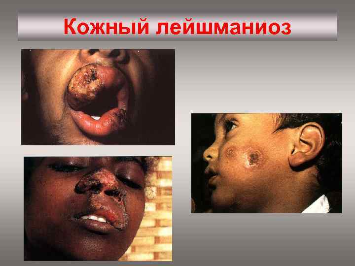 Кожный лейшманиоз 