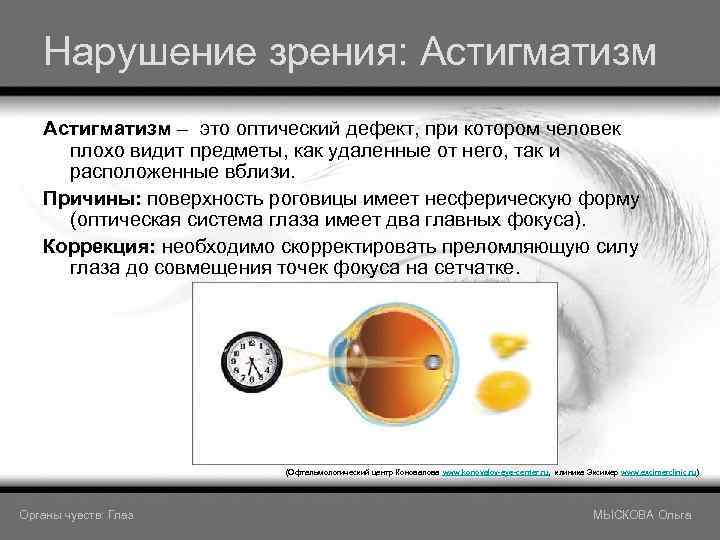 Нарушение зрения: Астигматизм – это оптический дефект, при котором человек плохо видит предметы, как
