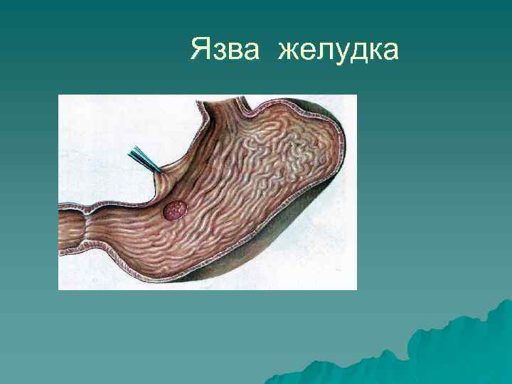 Язва желудка 