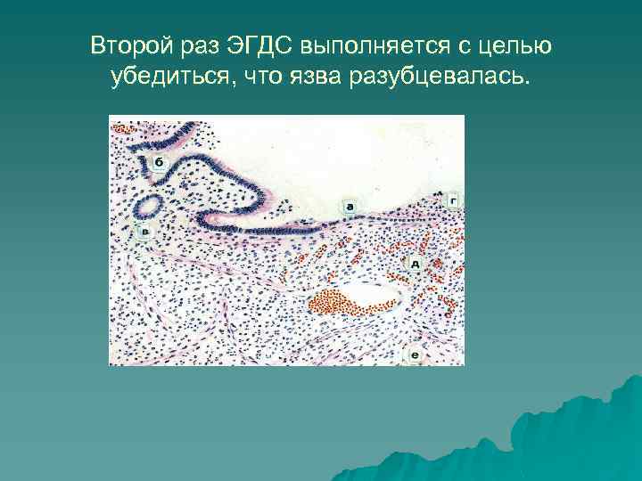 Второй раз ЭГДС выполняется с целью убедиться, что язва разубцевалась. 