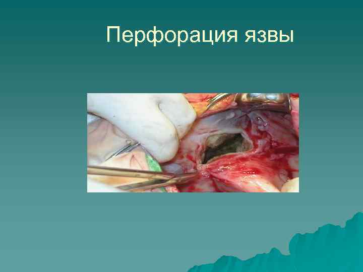 Перфорация язвы 