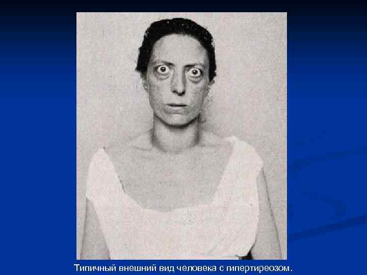 Типичный внешний вид человека с гипертиреозом. 