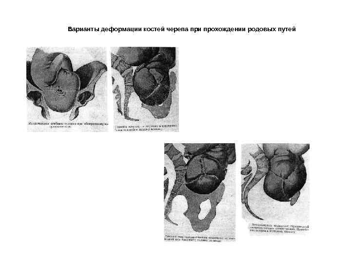 Варианты деформации костей черепа при прохождении родовых путей 