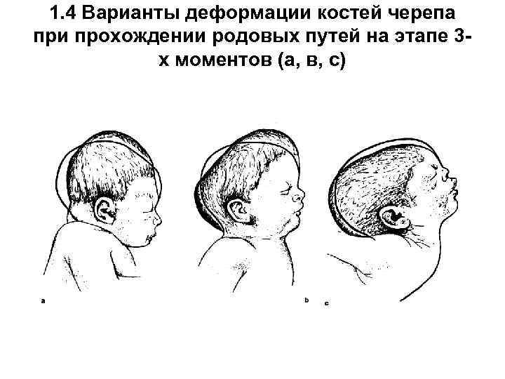 1. 4 Варианты деформации костей черепа при прохождении родовых путей на этапе 3 х