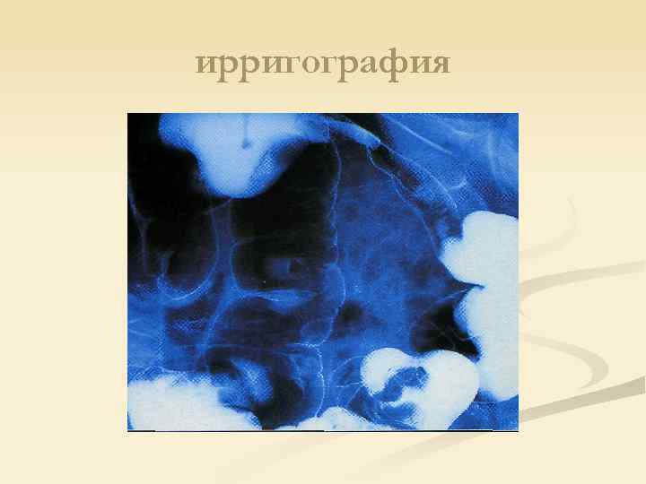 ирригография 
