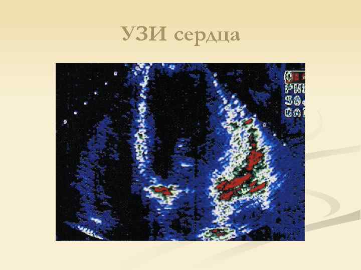 УЗИ сердца 
