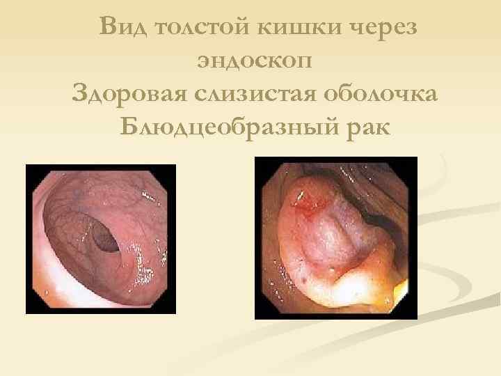 Вид толстой кишки через эндоскоп Здоровая слизистая оболочка Блюдцеобразный рак 