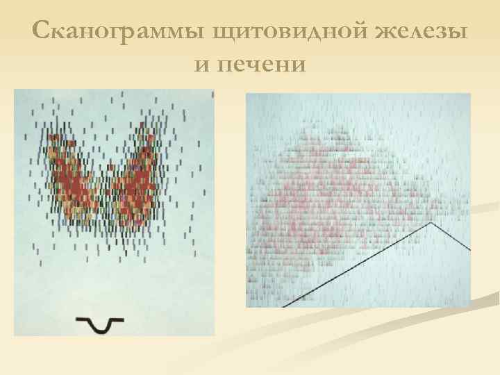 Сканограммы щитовидной железы и печени 