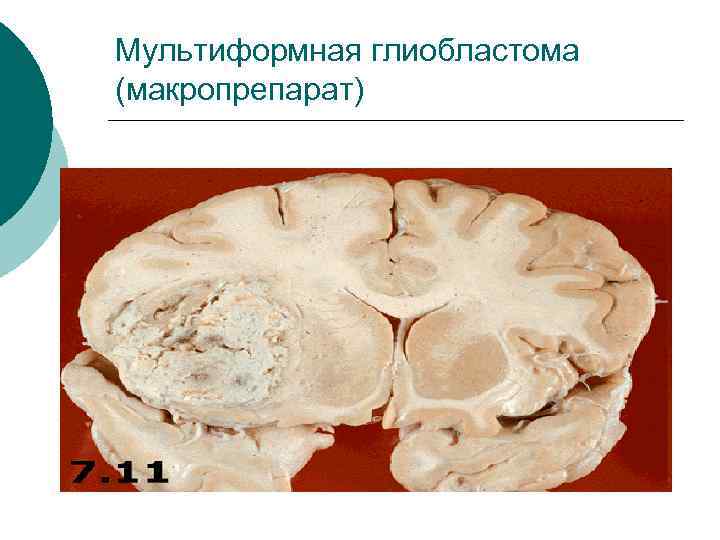 Мультиформная глиобластома (макропрепарат) 