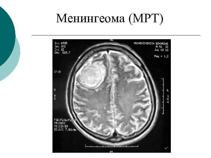 Менингеома (МРТ) 