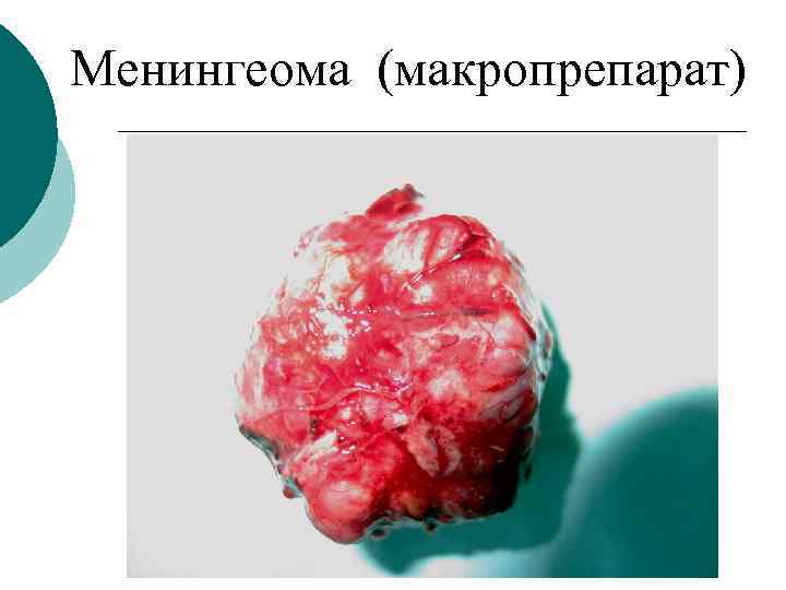 Менингеома (макропрепарат) 
