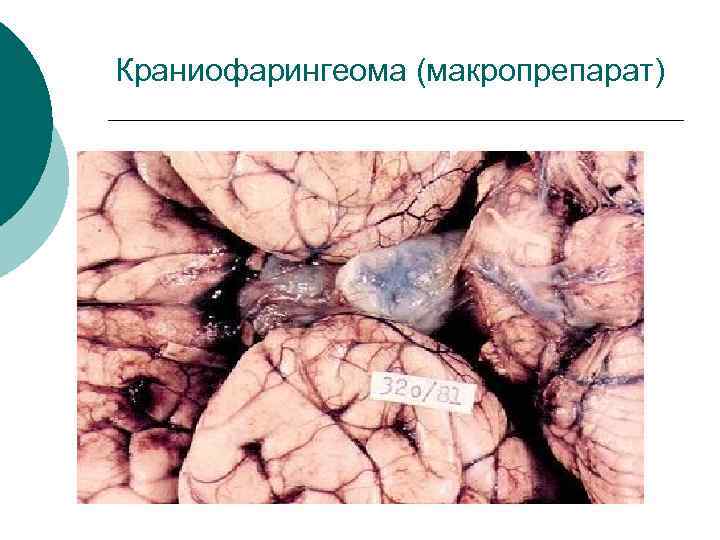 Краниофарингеома (макропрепарат) 