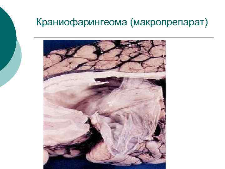 Краниофарингеома (макропрепарат) 