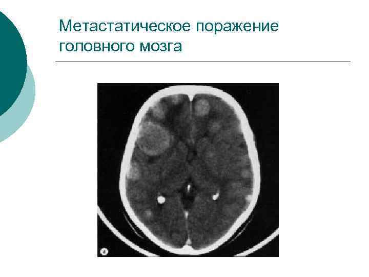 Метастатическое поражение головного мозга 