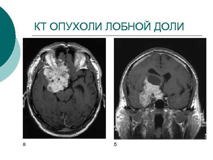 КТ ОПУХОЛИ ЛОБНОЙ ДОЛИ 