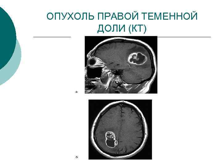 ОПУХОЛЬ ПРАВОЙ ТЕМЕННОЙ ДОЛИ (КТ) 