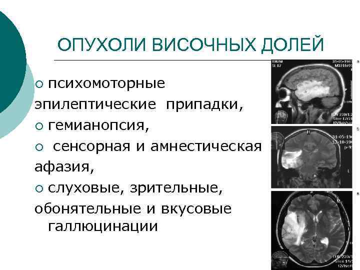 ОПУХОЛИ ВИСОЧНЫХ ДОЛЕЙ психомоторные эпилептические припадки, ¡ гемианопсия, ¡ сенсорная и амнестическая афазия, ¡