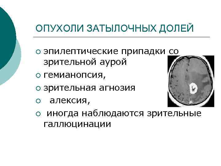 ОПУХОЛИ ЗАТЫЛОЧНЫХ ДОЛЕЙ эпилептические припадки со зрительной аурой ¡ гемианопсия, ¡ зрительная агнозия ¡