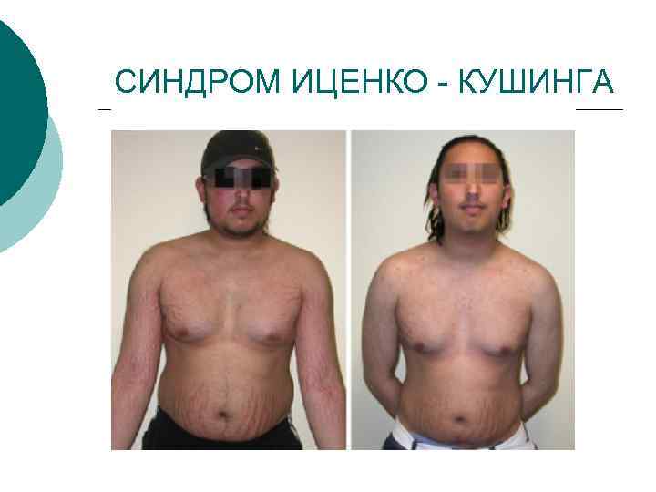  СИНДРОМ ИЦЕНКО - КУШИНГА 