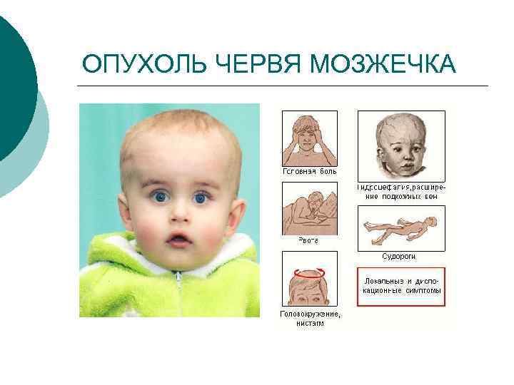 ОПУХОЛЬ ЧЕРВЯ МОЗЖЕЧКА 