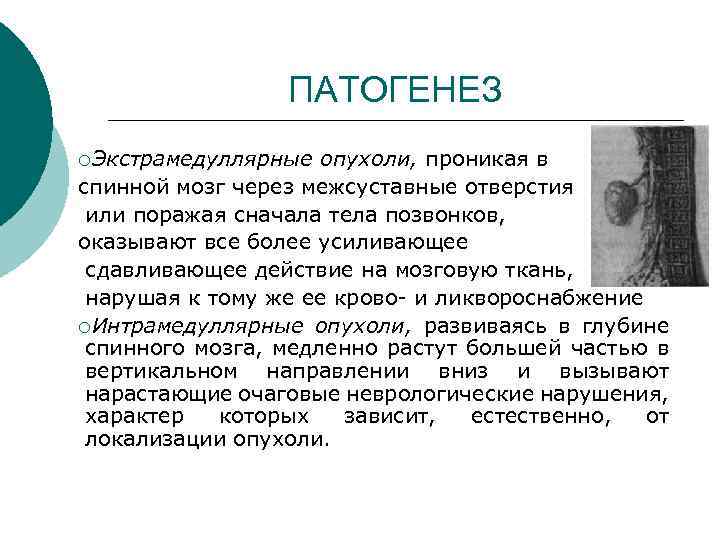 ПАТОГЕНЕЗ ¡Экстрамедуллярные опухоли, проникая в спинной мозг через межсуставные отверстия или поражая сначала тела
